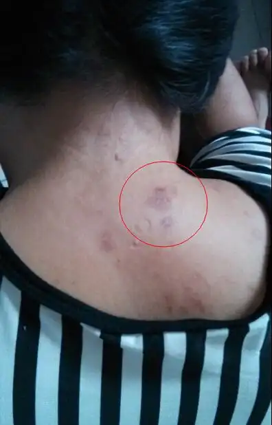 这个位置去医院拍了片也没说出个所以然来,肿了一个硬块,外面按和脖子