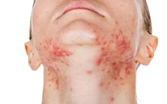 花柳病症状男图片 - 搜狗图片搜索