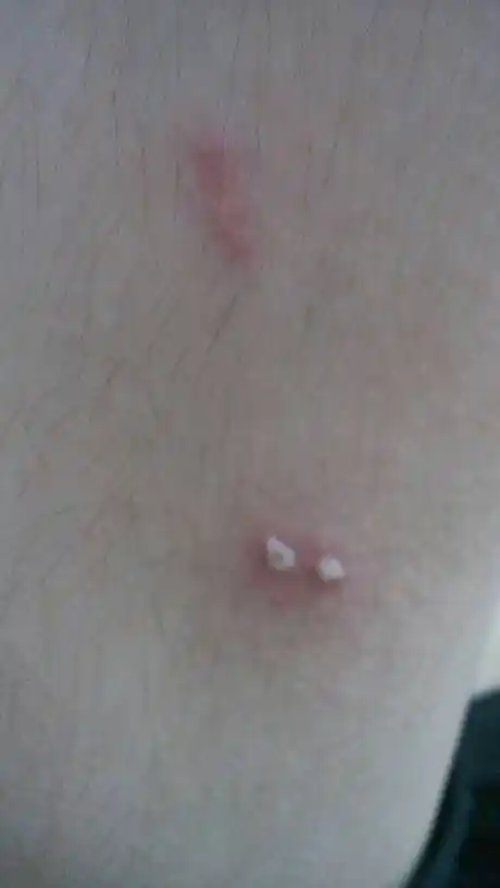 大腿上有脓包,没处理过,怎么办.不想去医院