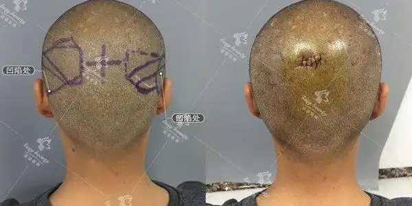 后脑勺凹陷,侧面看脑袋像一颗长长的土_新氧美容整形