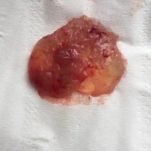 试管移植35天流血掉下来一个膜样的东西,请问这是什么啊,是孕囊吗?