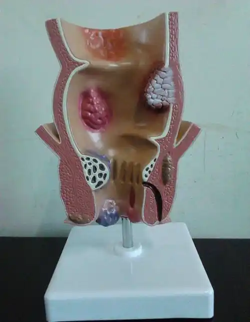 肛管直肠脱出时间过长会因直肠黏膜嵌顿而引起肿痛,糜烂,出血,坏死