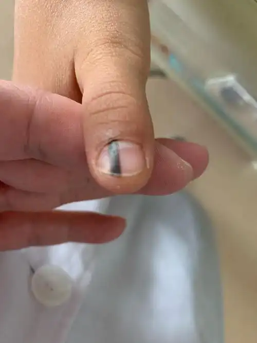 右手拇指甲母痣