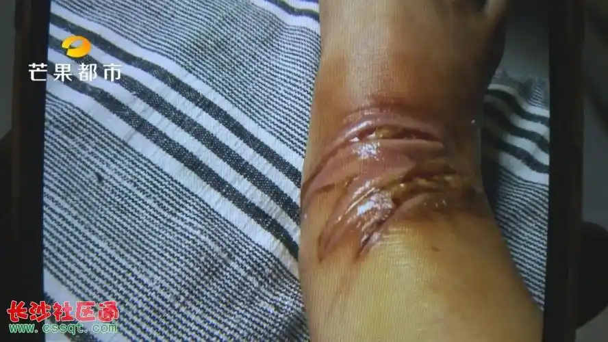 长沙女子接受全麻妇科手术 醒后发现右脚被烫伤 转院