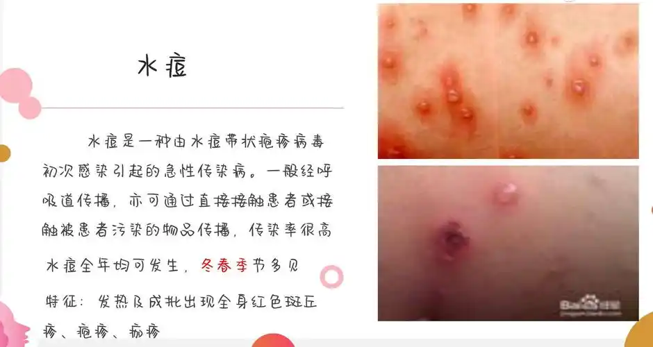 下面是水痘的认识与特征
