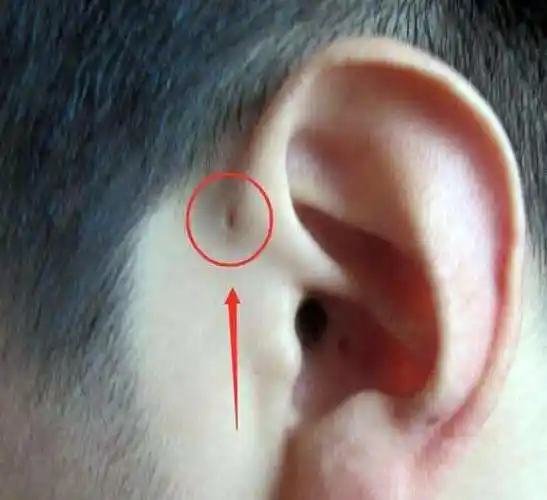 宝宝出生耳朵上有这个就是富贵命民间俗称仓眼