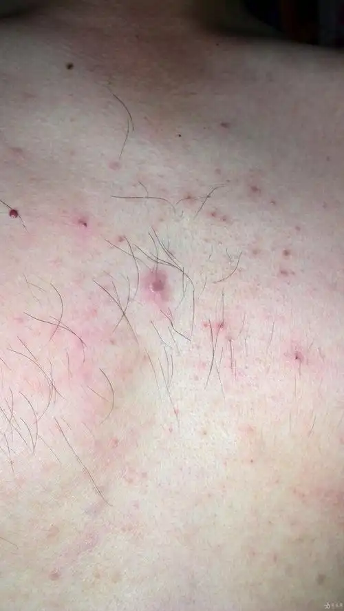 胸口上红点不痛不痒已经有半个月之久