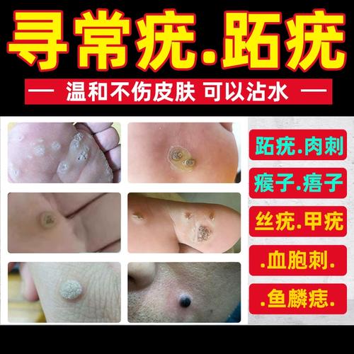 跖疣膏寻常疣手上长疣硬疙瘩瘊子肉刺根脚底非病毒去除神器专用膏