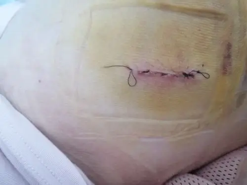 切口美容缝合,愈合满意后几乎不留疤痕.