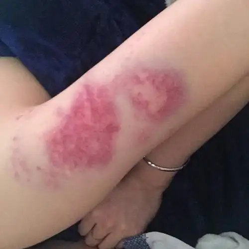 打架胳膊上的红肿,淤青如何快速消除?