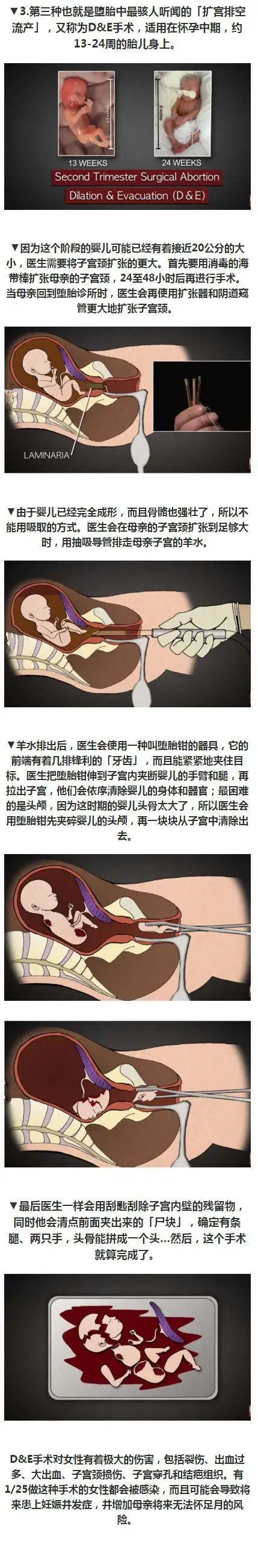 引产男孩女孩区别图片流产手术过程图解打胎过程打胎过程图解堕胎手术