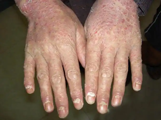 大人湿疹症状图片_有来医生