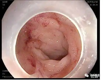 小儿便血很有可能是息肉惹的祸!