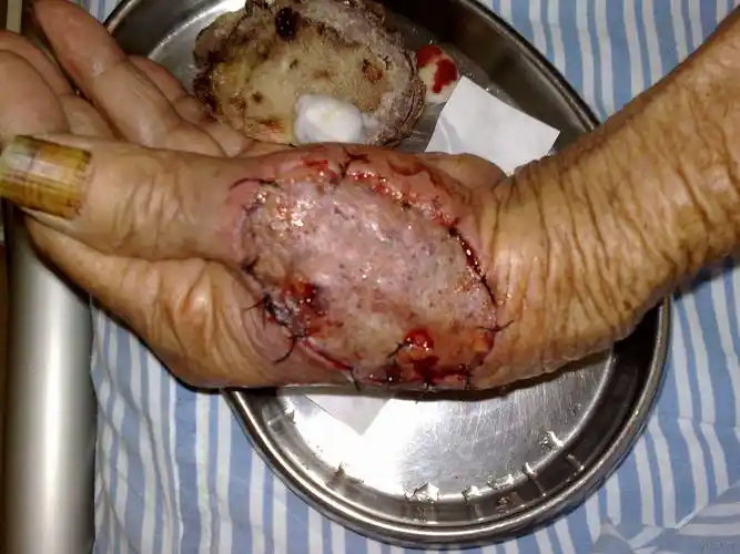 皮肤癌一例治疗过程