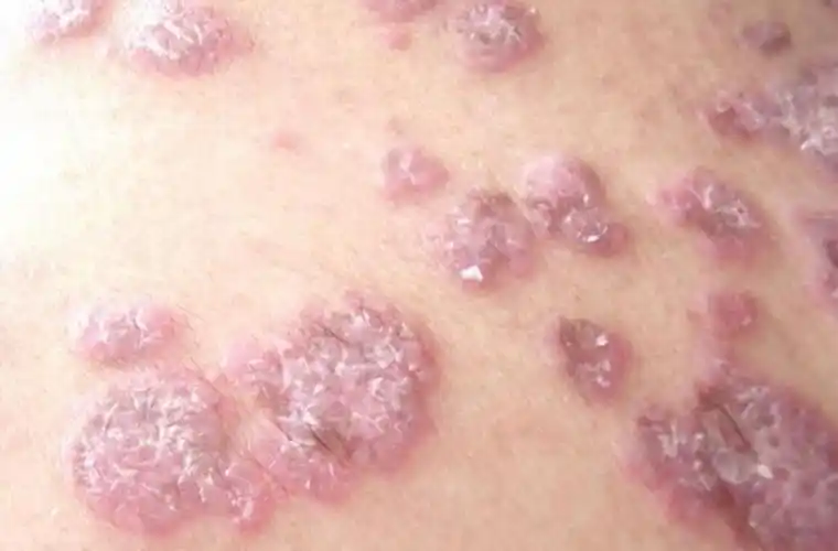 系统性红斑狼疮男性面部症状图