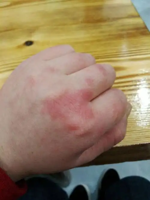 手上一直有红红的一片,是红斑?