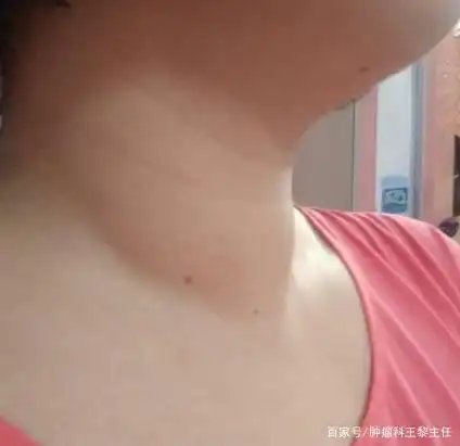 乏力,食欲不振,颈部肿大,看中医如何治疗