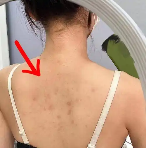 过来人分享根除小妙招!居家洗洗后背秒光滑!_祛痘_皮肤_个人