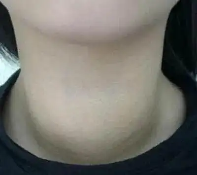 一,甲状腺肿:这是甲亢比较典型的症状之一,即颈部处的甲状腺增大.