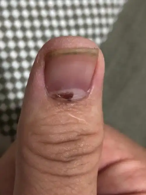 指甲内侧有红色血迹怎么回事