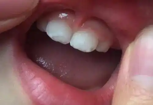 宝宝牙齿出现白斑!妈妈们赶紧了解一下乳牙脱矿