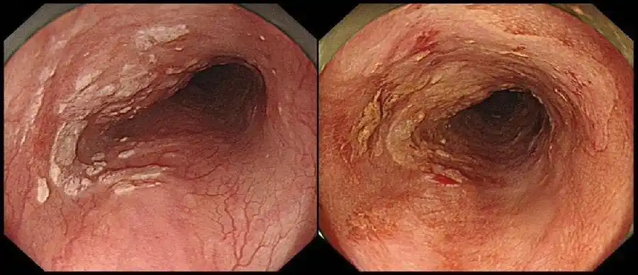 早期食管癌(图谱)系列:白光与碘染