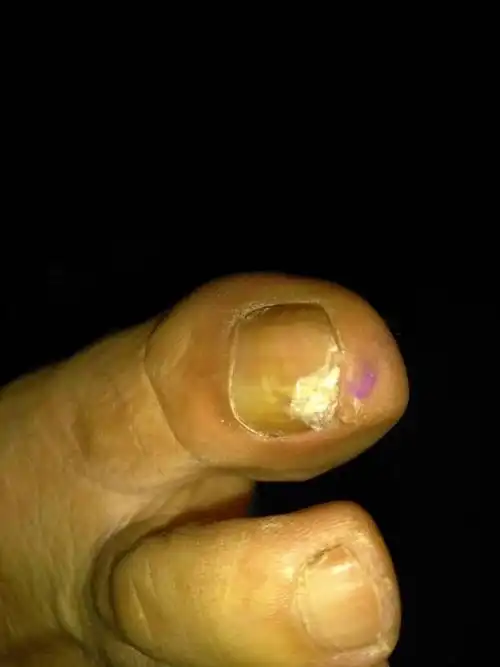 我母亲大脚趾指甲变厚里面变空变腐有很多年只是打脚趾指甲我大姨妈和