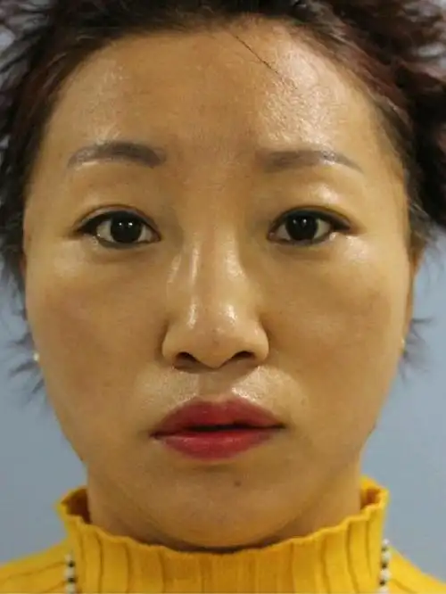 【术前诊断】:中下面部松弛 上眼睑下垂【方案设计】_圈子-新氧美容