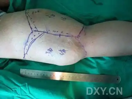 大腿巨大侵袭性纤维瘤(硬纤维瘤病)切除术,欢迎大家讨论! [精华]