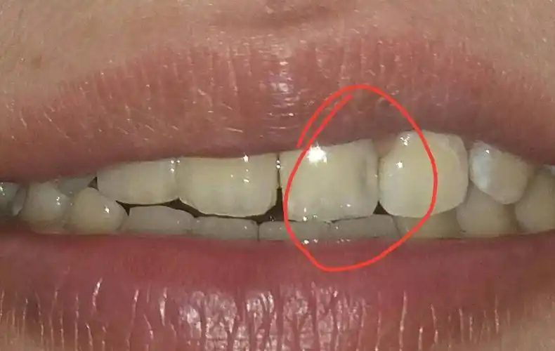 突然发现自己门牙蛀牙了,怎么办,应该怎么治理,需要切吗