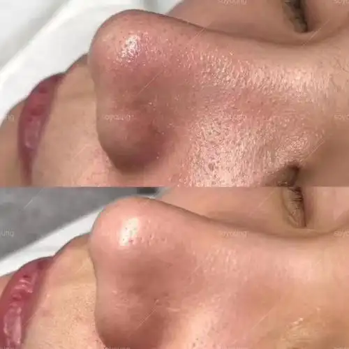 痘没办法把毛孔里的垃圾给吸出来,都会定期做气泡清洁他们家美容师