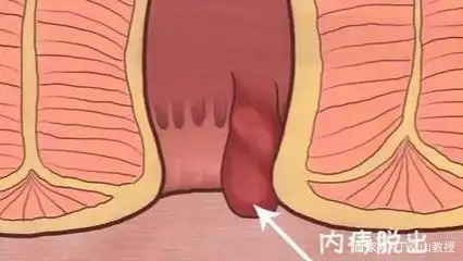 上厕所肛门居然掉出一块"小肉球",该怎么办?