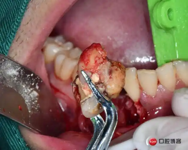 清好的囊腔内放置骨胶原蛋白:因为牙龈退缩非常明显特别是唇侧;所以松