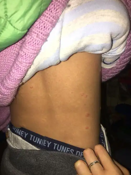 宝宝身上到处都长红色的小脓包,急