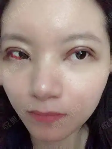 全切双眼皮术后3天_双眼皮术后3天_眼部整形术后3天_袹褵,鈈囄分享