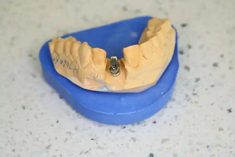 前牙种植美容修复