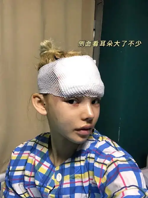 项目玻尿酸丰精灵耳