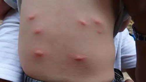 对称皮肤病图片_有来医生