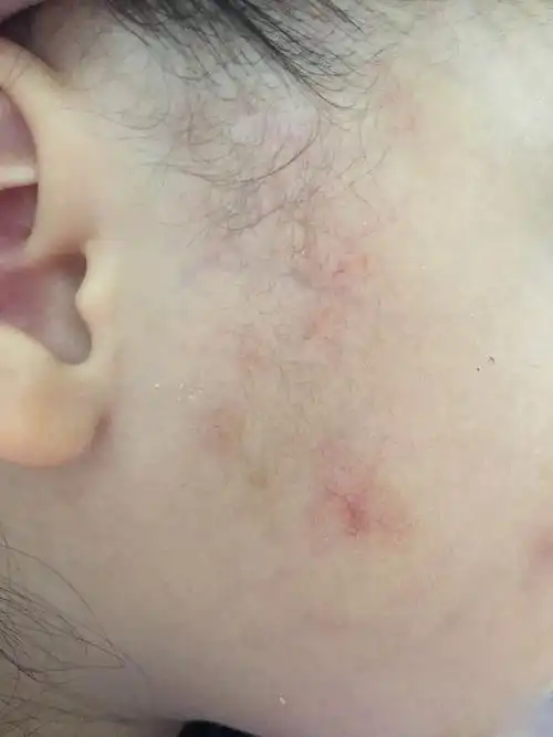 乙肝蜘蛛痣早期图片 (40)