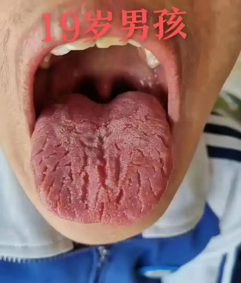上热门话题979797 #舌诊 #裂纹舌,这种舌头分先天和 - 抖音