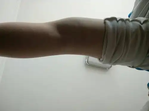 腘窝凸起,分不清是腘窝囊肿还是肉多