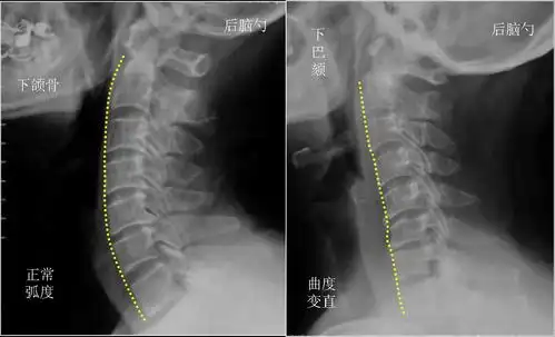 仁爱!颈椎曲度变直是怎么回事?"那么便宜"-第2张图片-宠宝网