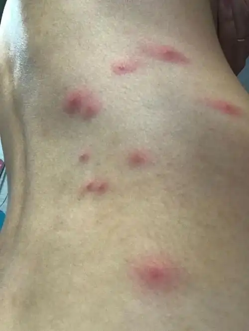 皮肤科医生告诉你:如何分辨身上的这些「小疙瘩」