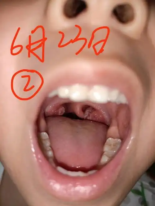 扁桃体3度肿大到1度