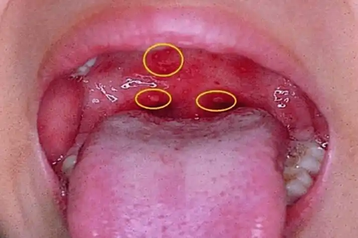 口腔硬腭有红点图片_有来医生