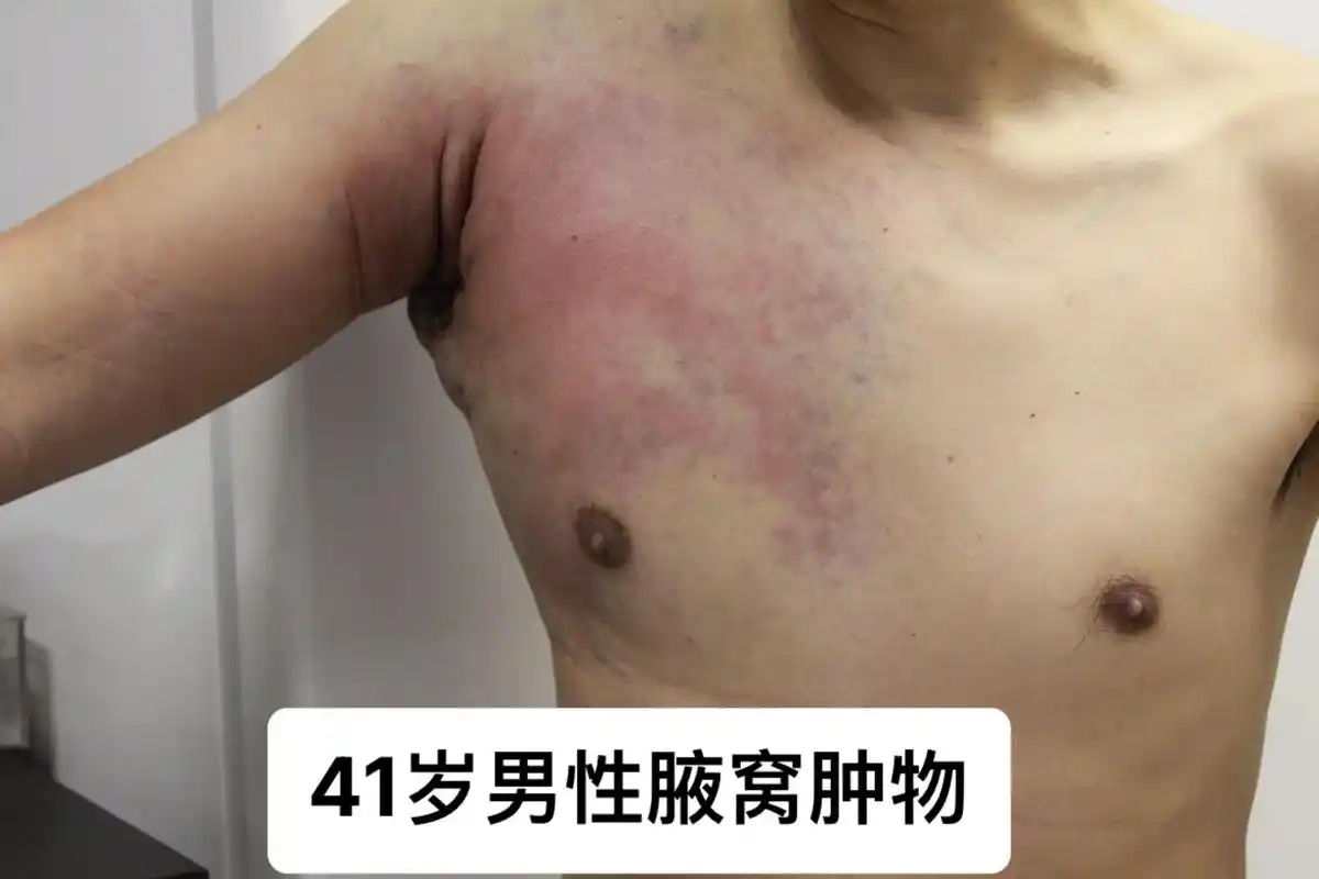 男性腋窝肿物和溃疡.#病理学 #细针穿刺 #淋巴瘤 #弥漫大 - 抖音