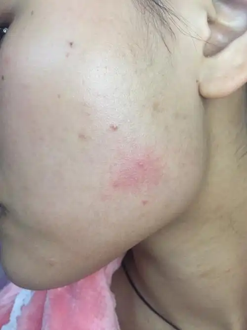 杨教授好,我16年9月份被您确诊为玫瑰痤疮,10月开始吃米诺环素,丘疹