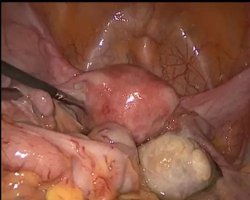 腹腔镜下卵巢巧克力囊肿剥除术