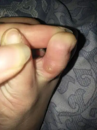 脚无名指上长了个包,有点硬,一捏就疼,穿鞋走路也疼,什么情况?