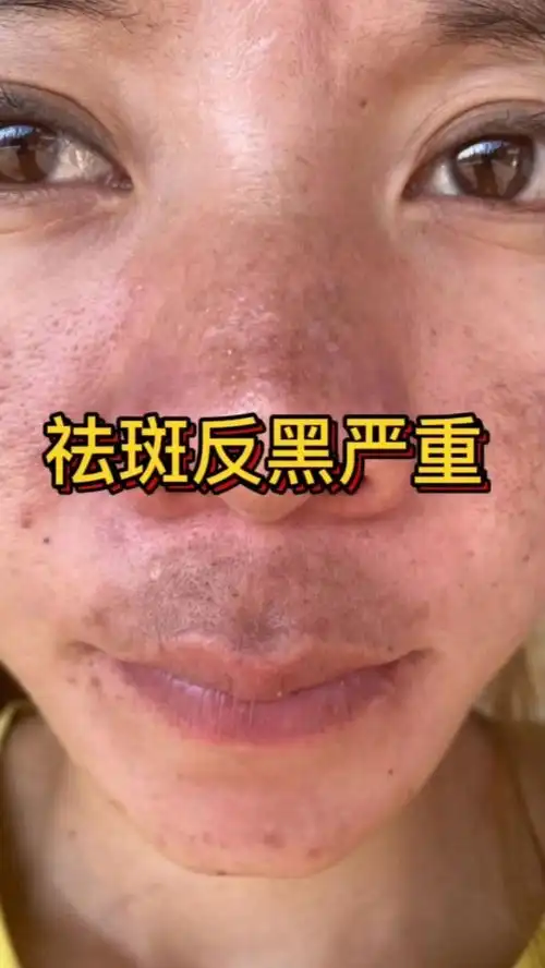 个人祛斑记录反黑严重到干干净净这次终于选对了